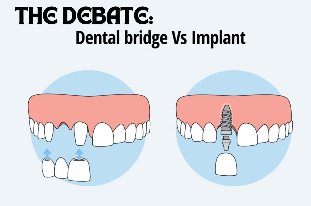 an image of The Debate: Healthy Teeth vs. Implants